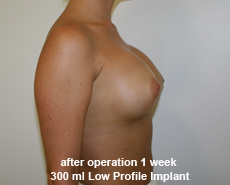 plastic-surgery-breast-augmentation